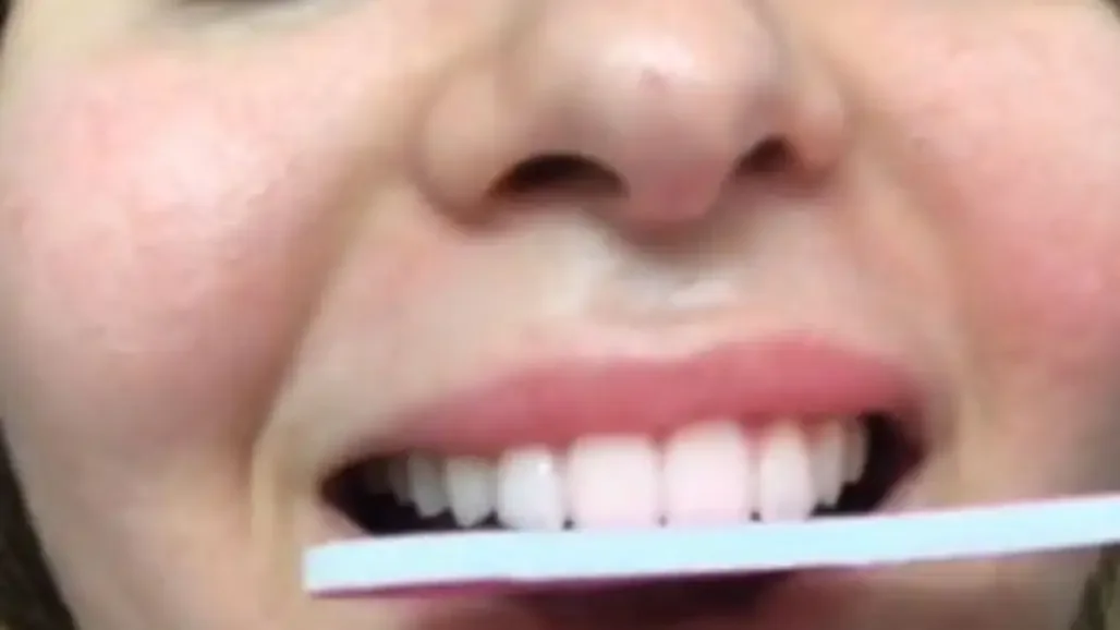 Odontólogo advirtió sobre los peligros de limarse los dientes, una tendencia viral de los más jóvenes, que se replica en las redes sociales