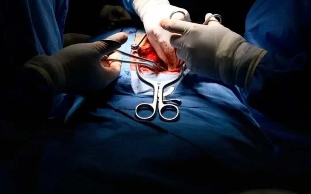 China logra el primer trasplante de hígado de cerdo modificado genéticamente en un humano