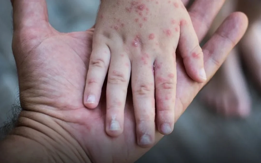Alerta epidemiológica en Buenos Aires: casos de sarampión confirmados