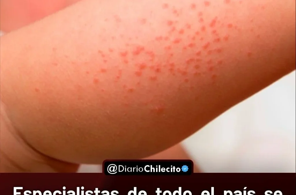 Especialistas de todo el país se unen en campaña para detectar dermatitis atópica