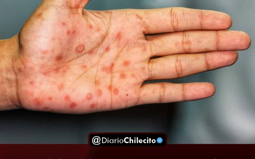 El Ministerio de salud nacional confirmó un aumento del 38,5% en sífilis. La mayoría de los casos afecta a personas de 15 a 39 años