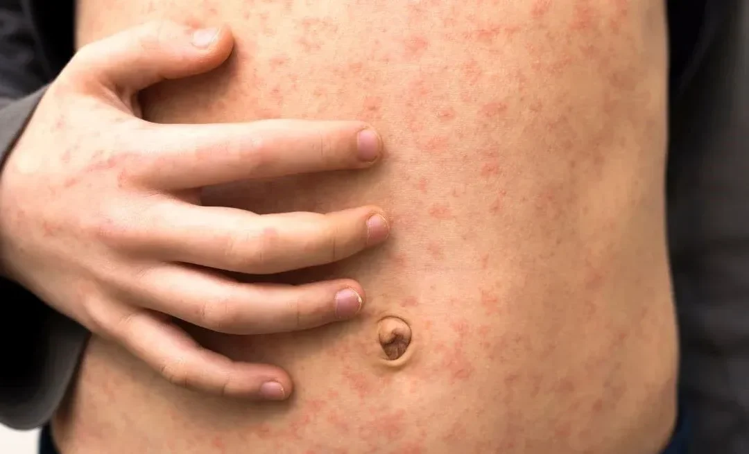 Crece el sarampión en Argentina, y Chile refuerza su campaña de vacunación argumentando prevención epidemiológica