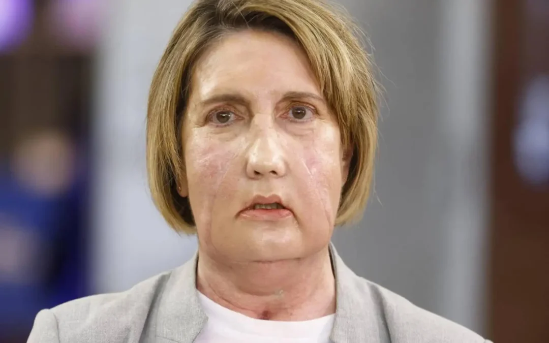 Hito médico en España: Primer trasplante de cara del mundo con una donante de eutanasia