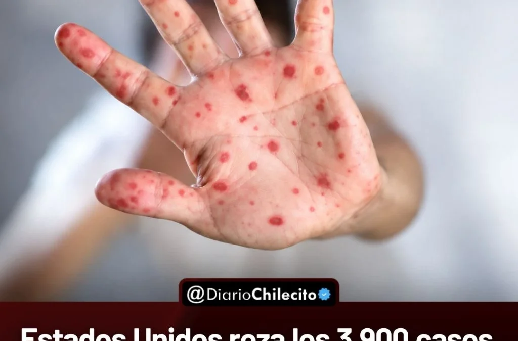 Estados Unidos roza los 3.900 casos de sarampión y Nueva York declaró la emergencia sanitaria.